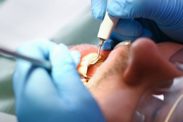 Best Chipped Tooth Repair Near Me  in St Petersburg, FL